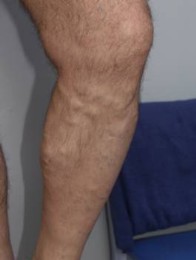 varicose veins